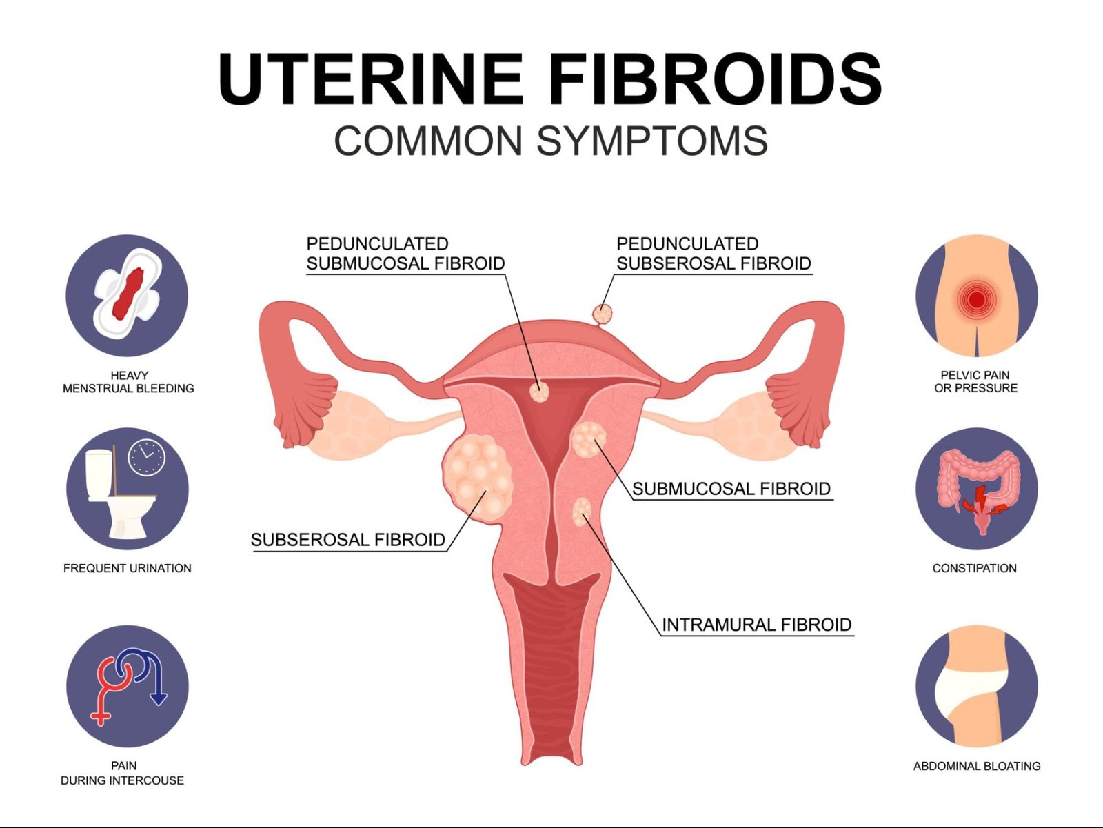 Understanding Uterine Fibroids: Symptoms, Myths, and Management
